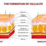 Cellulit - domowe sposoby i zabiegi lecznicze
