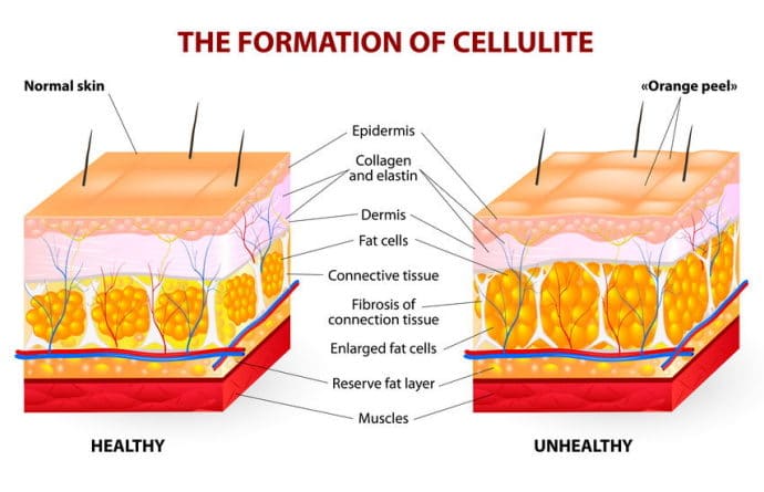 Cellulit – domowe sposoby i zabiegi lecznicze